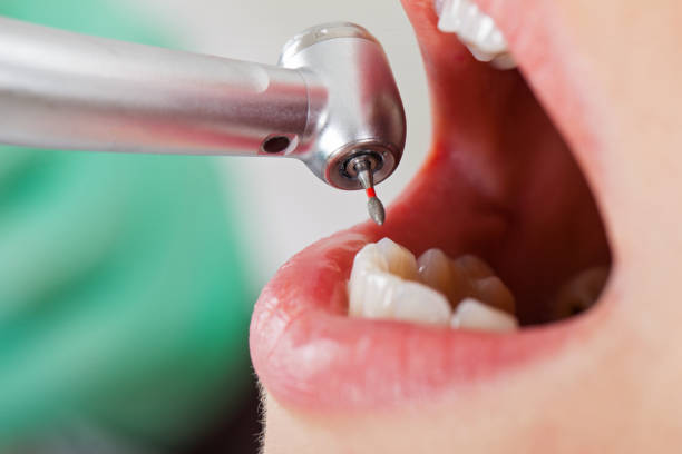 Best Emergency Dental Extractions in Barstow, CA